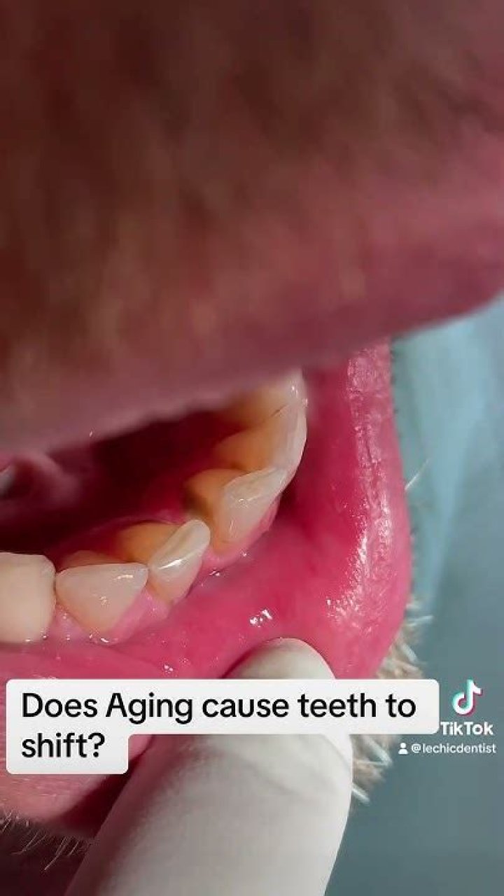 Does aging cause teeth to shift?
