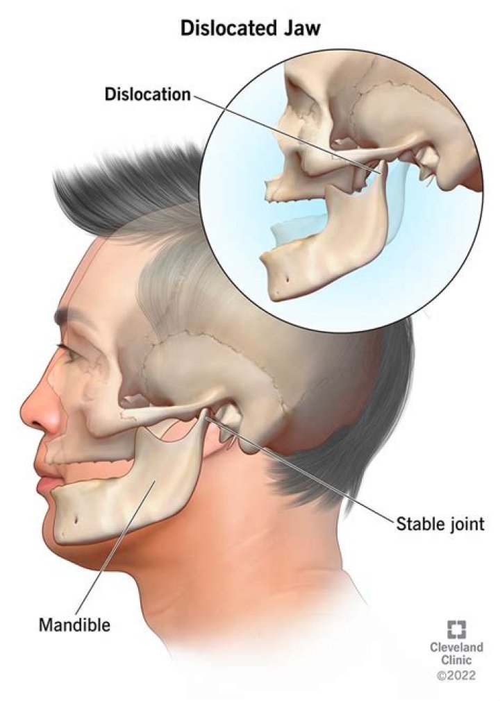 How do you fix a deteriorating jaw bone?