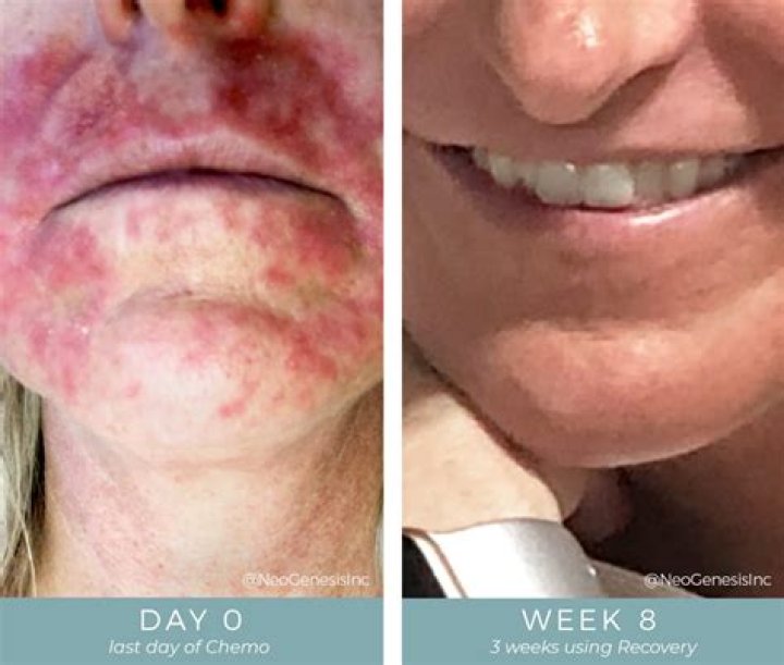 How many times a week do you get chemo?