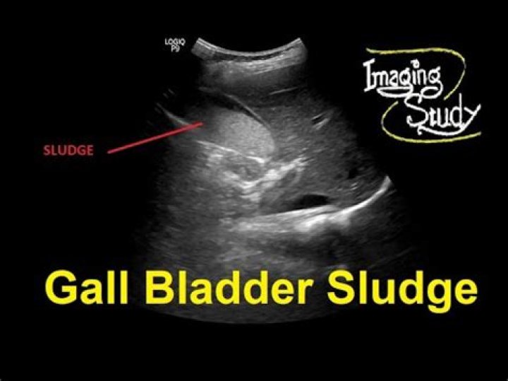 What color is gallbladder sludge?