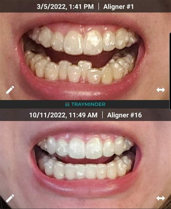 What happens if you don't wear Invisalign 22 hours a day?